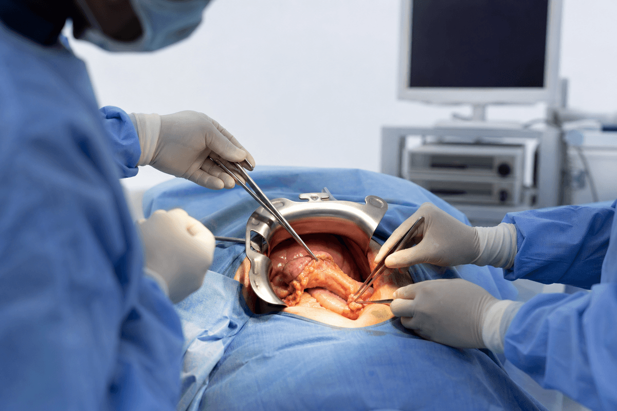 Pancreatic Cancer Surgery